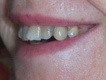 denture after