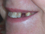 denture before