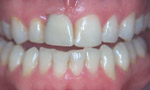 Gentle Dental Cosmetic Dentist Salisbury. Whitening, Veneers