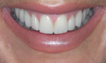 Gentle Dental Cosmetic Dentist Salisbury. Whitening, Veneers