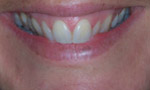 Gentle Dental Cosmetic Dentist Salisbury. Whitening, Veneers