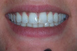 Gentle Dental Cosmetic Dentist Salisbury. Whitening, Veneers