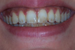 Gentle Dental Cosmetic Dentist Salisbury. Whitening, Veneers