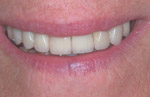 crowns and veneers