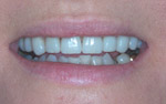 veneers