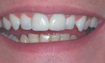 veneers and whitening