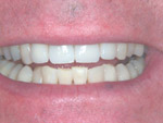 veneers and whitening