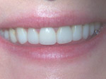 veneers